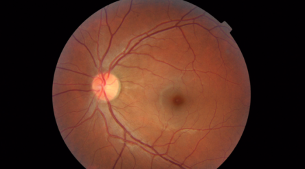 Image for Sales lag but Opthea shares jump on trials result