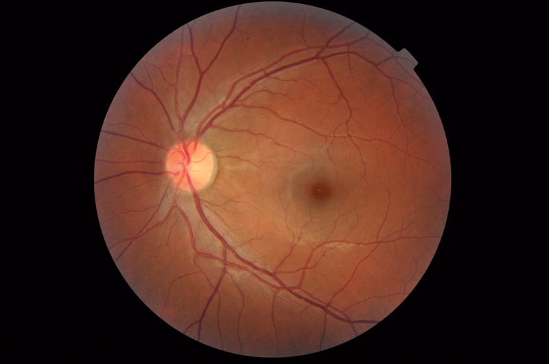 800px-Fundus_photograph_of_a_healthy_left_eye_(OS)_from_a_myopic_Asian_male_patient._Age_23