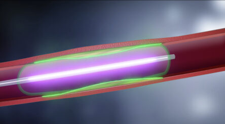 Image for New Australian drug delivered by balloon to patients