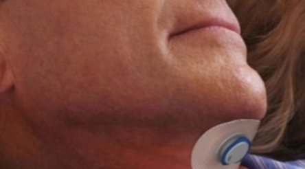 Image for Cochlear ups investment in sleep device