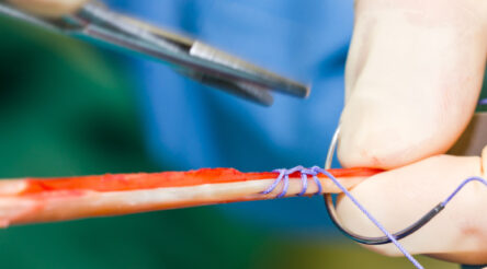 Image for Australia’s niche champions – commercialisation adventure keeps surgeon on the hop