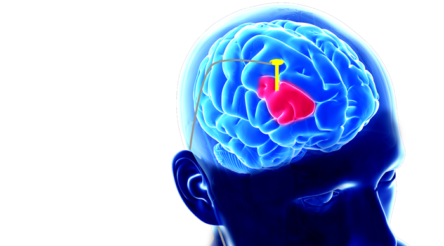 Image for $8.5 m in Global Linkages grants awarded to deep brain stimulation, sanitation chambers and other projects