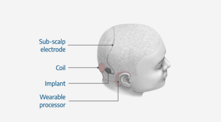 Image for Cochlear backs Epiminder capital raising