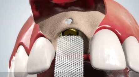 Image for Osteopore reaches dental implant development milestones