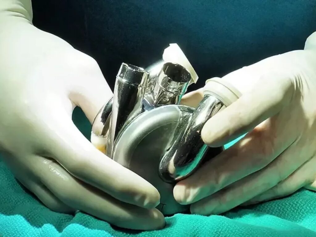 Unnamed patient becomes first outside of US to receive maglev artificial heart